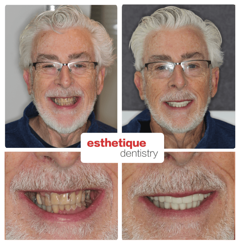 Before and after - Bill M.