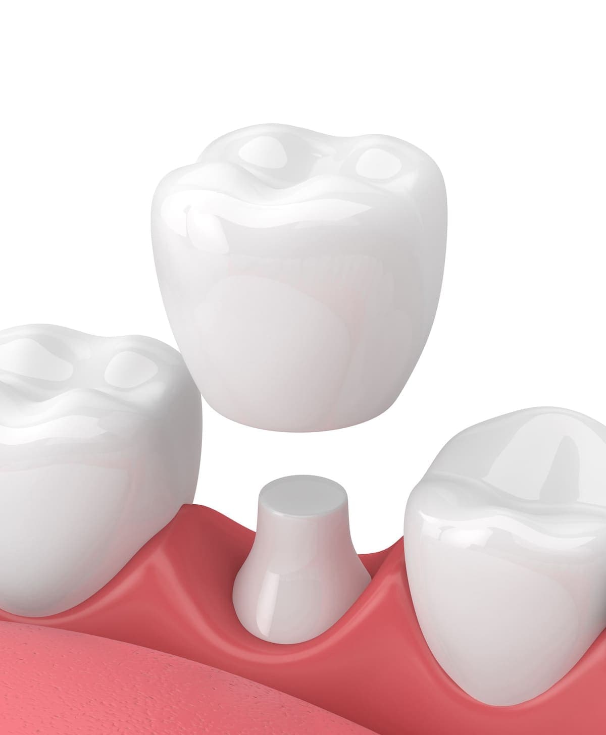 Illustration of a dental crown being placed over a prepared tooth