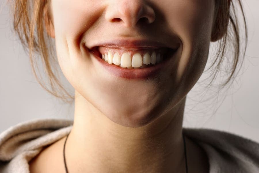 Close-up of teeth with visible white spots on the enamel