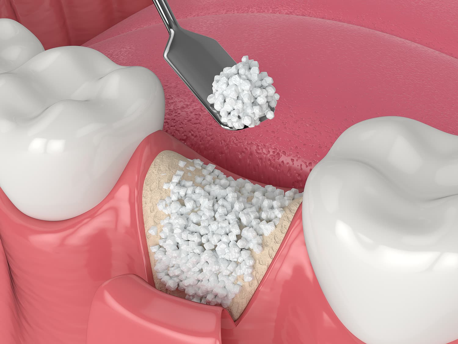 3D illustration of dental bone grafting procedure showing bone graft material being placed in Leesburg VA