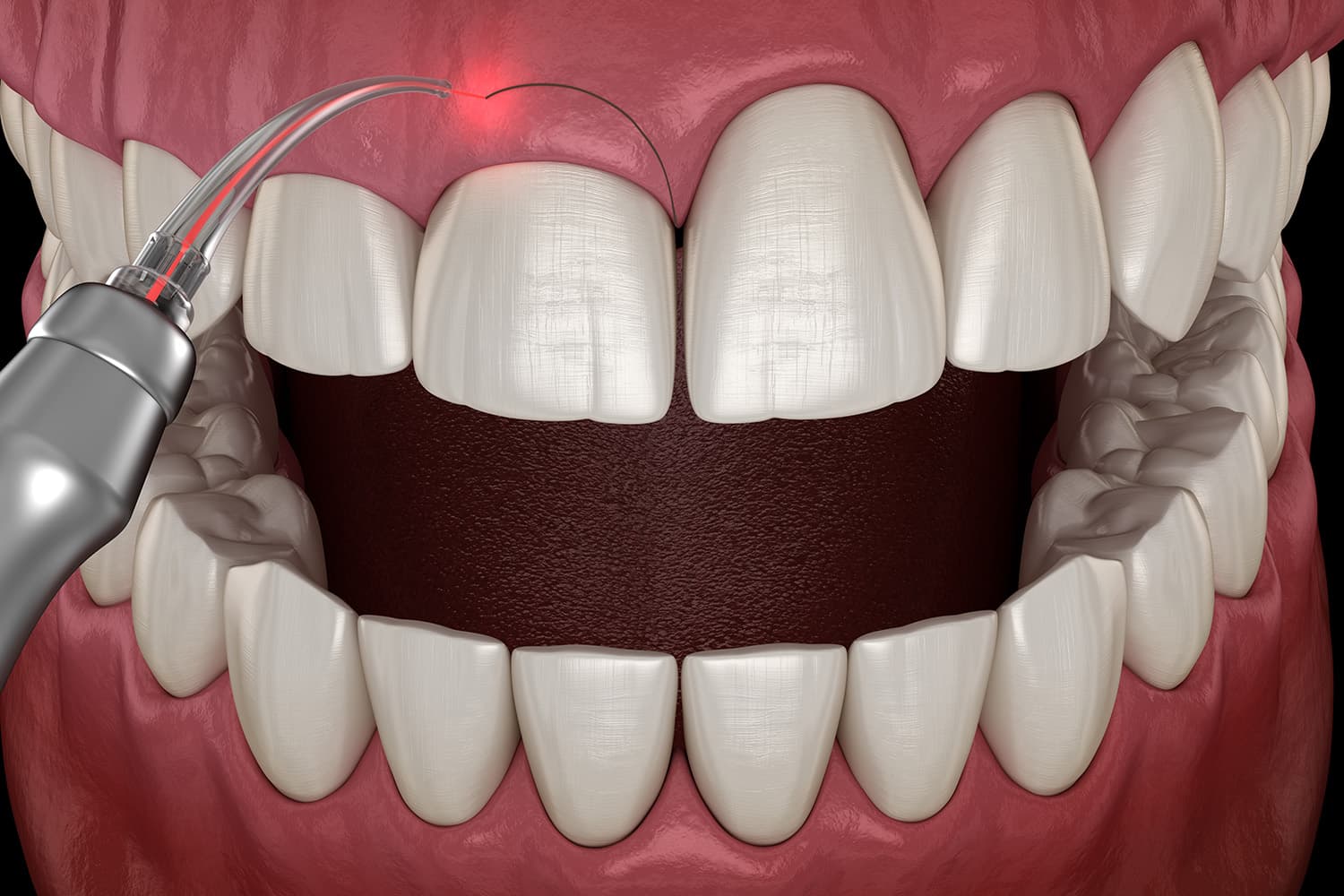3D illustration of laser gum contouring procedure in Leesburg VA