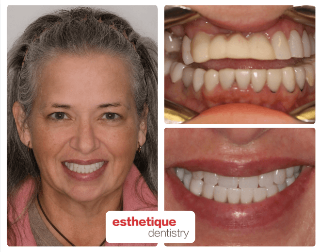 Before and after - Marcy P.
