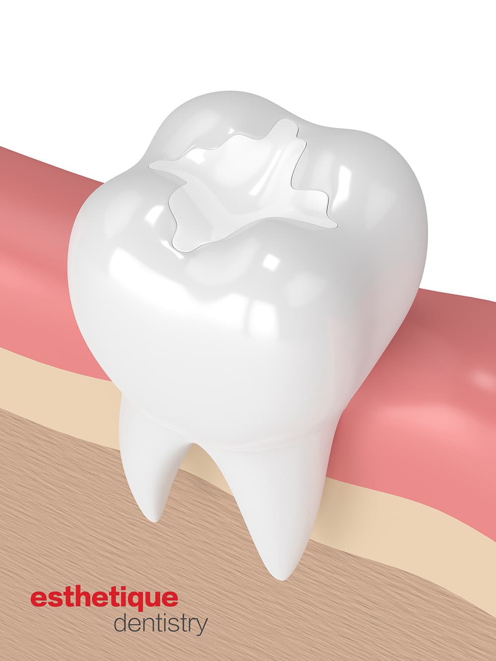 3D illustration of tooth-colored dental filling on a molar tooth in Leesburg VA