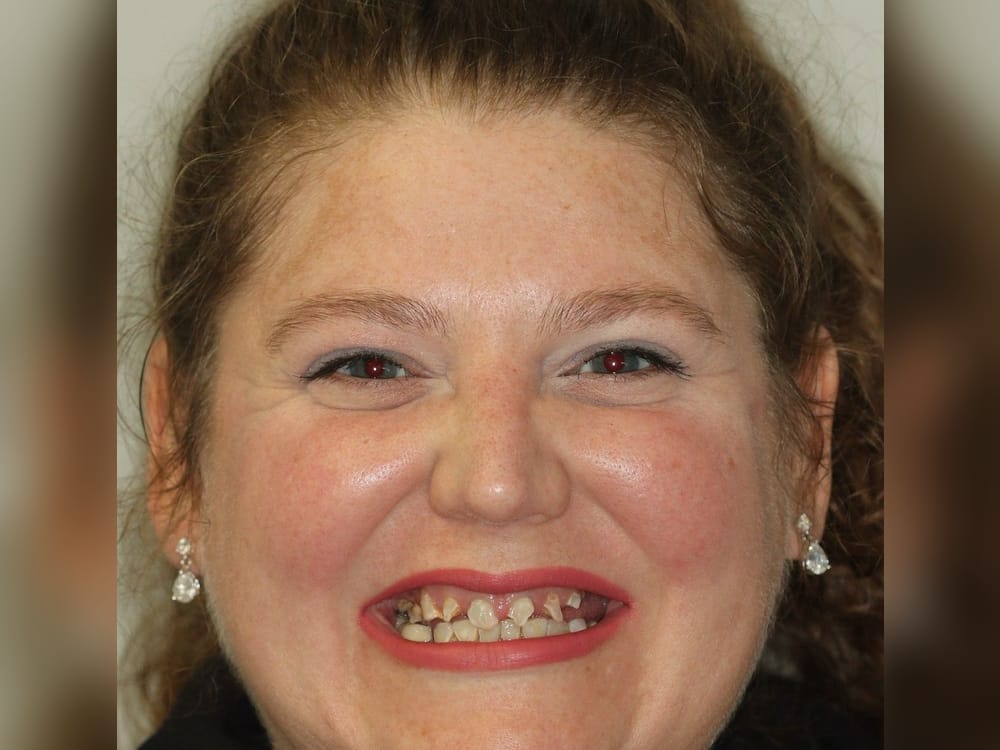 Full Mouth Reconstruction, before treatment